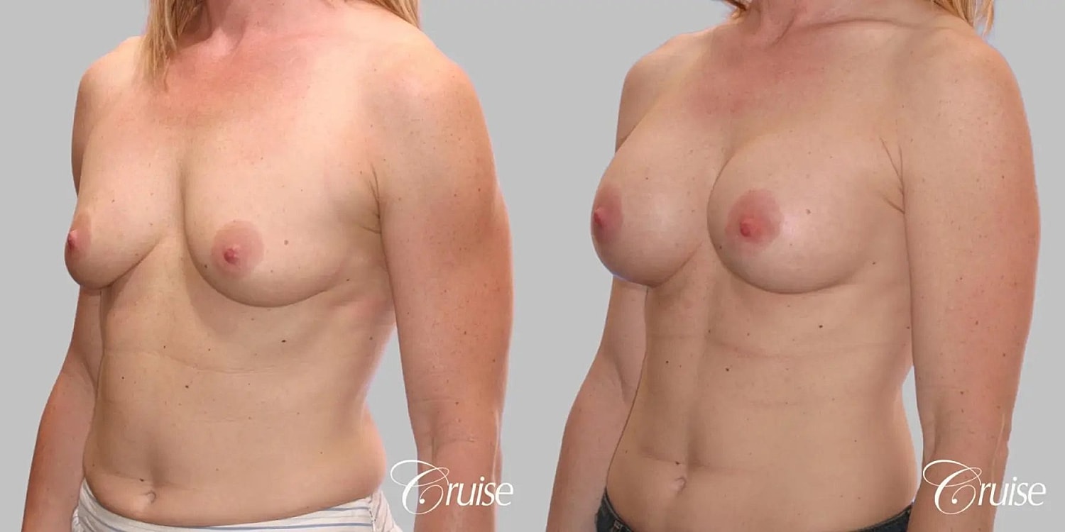Breast Augmentation Before & After