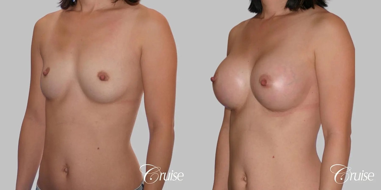 Breast Augmentation Before & After