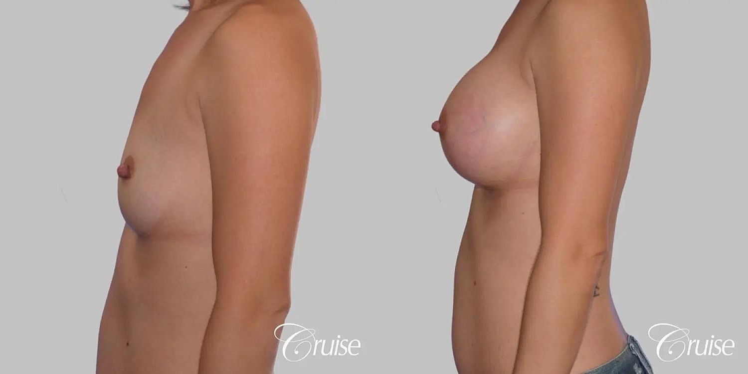 Breast Augmentation Before & After