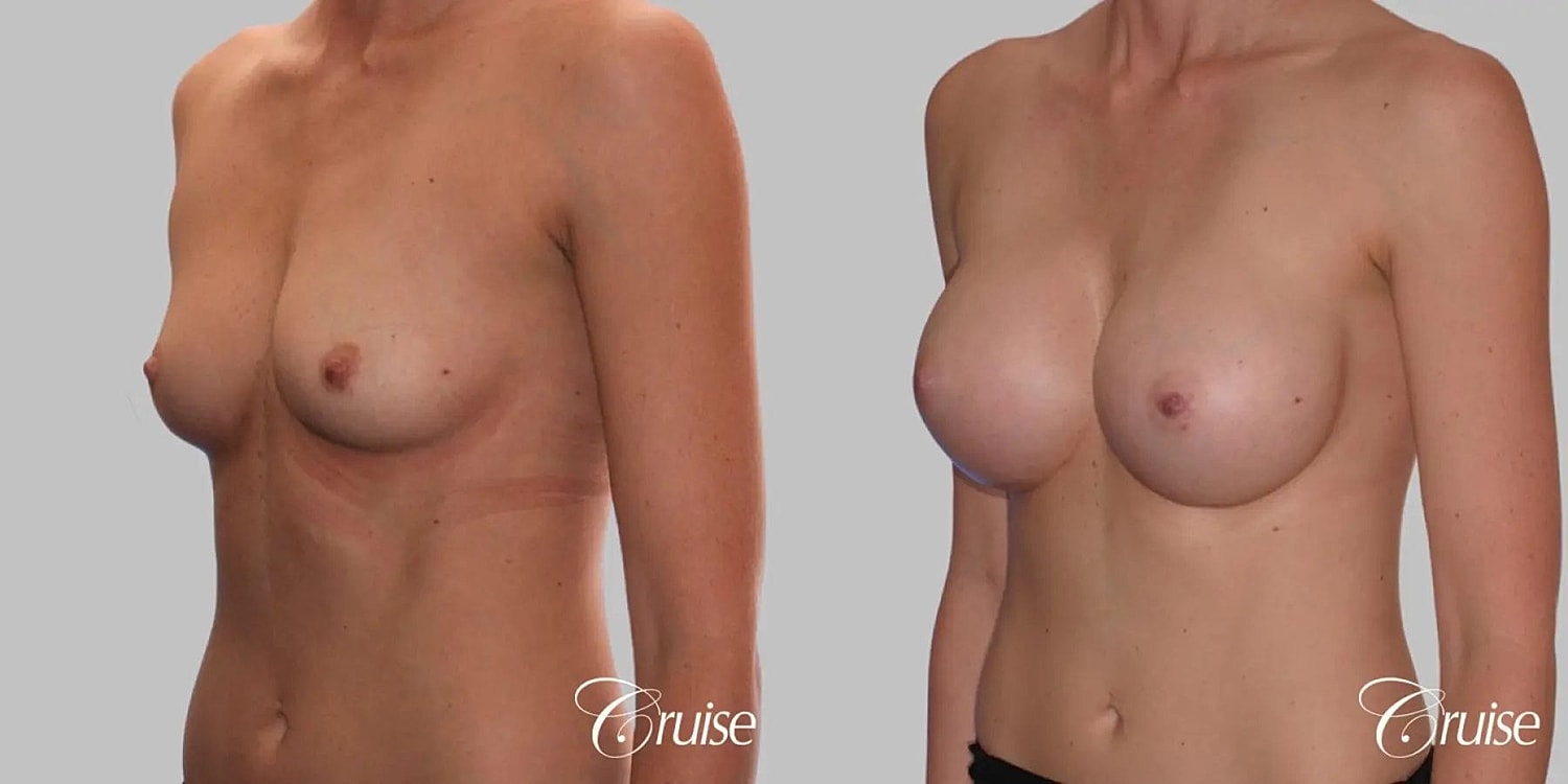 Breast Augmentation Before & After