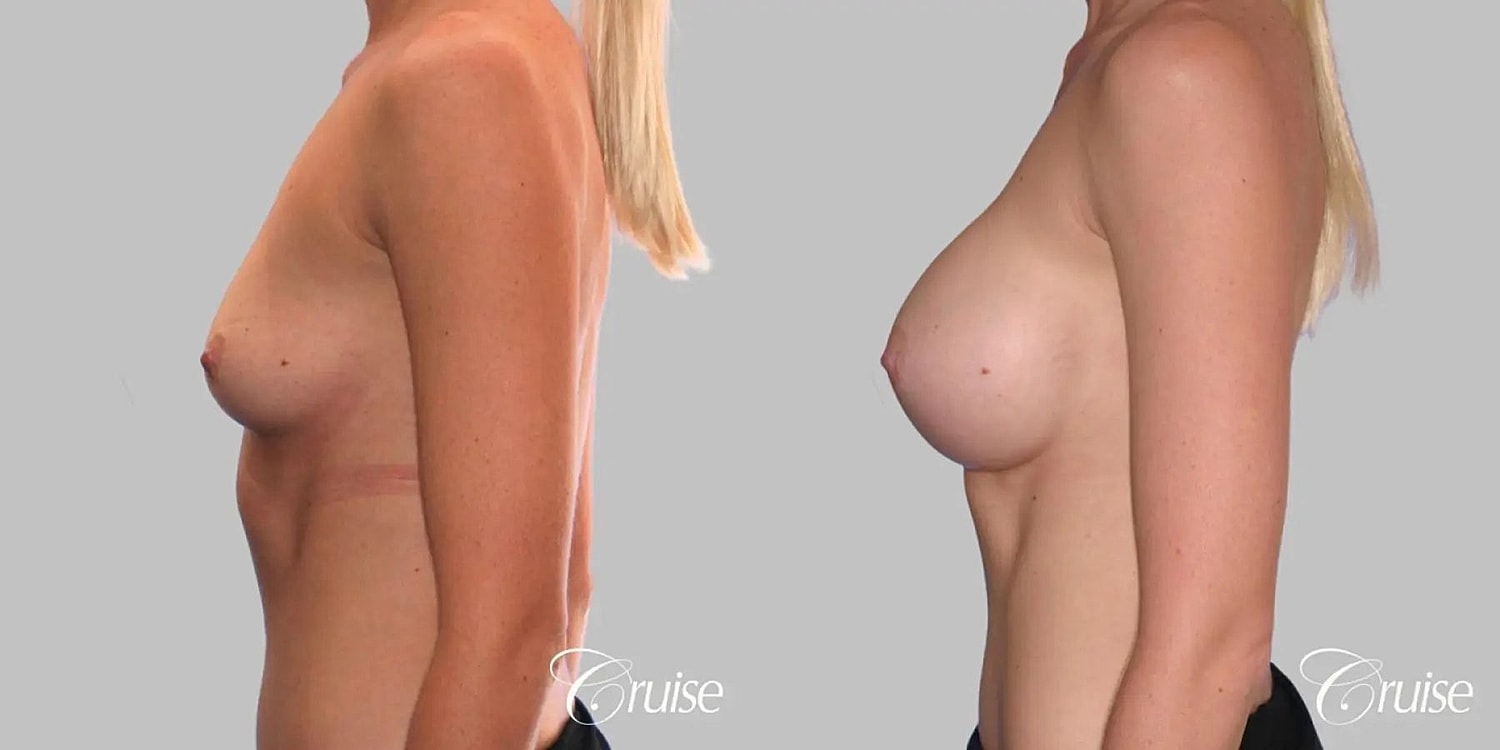 Breast Augmentation Before & After