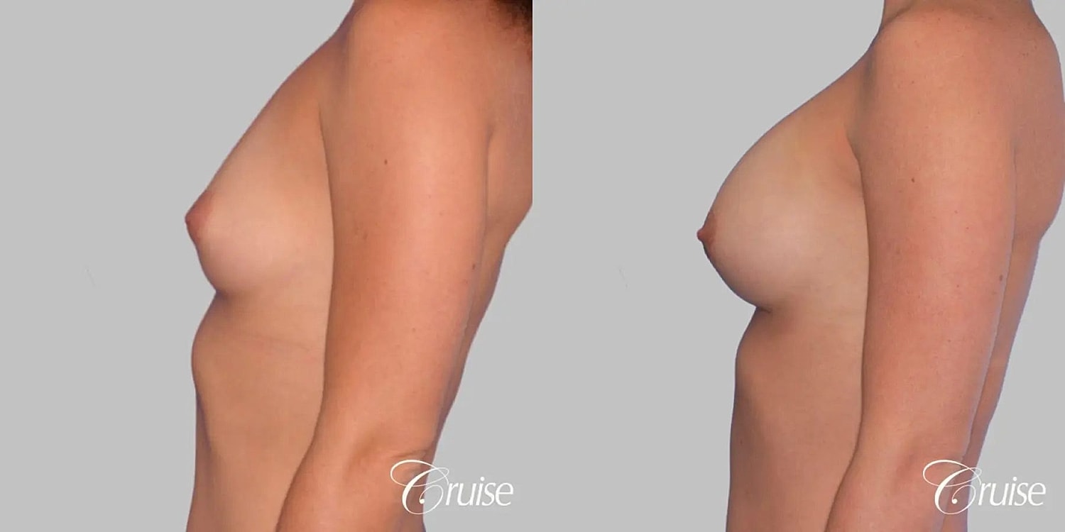 Breast Augmentation Before & After