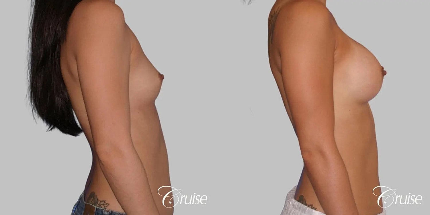 Breast Augmentation Before & After
