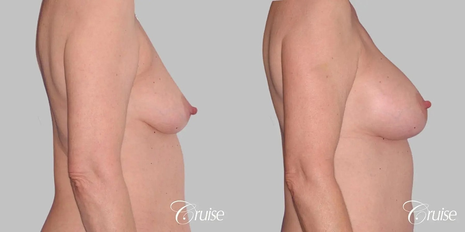 Breast Augmentation Before & After