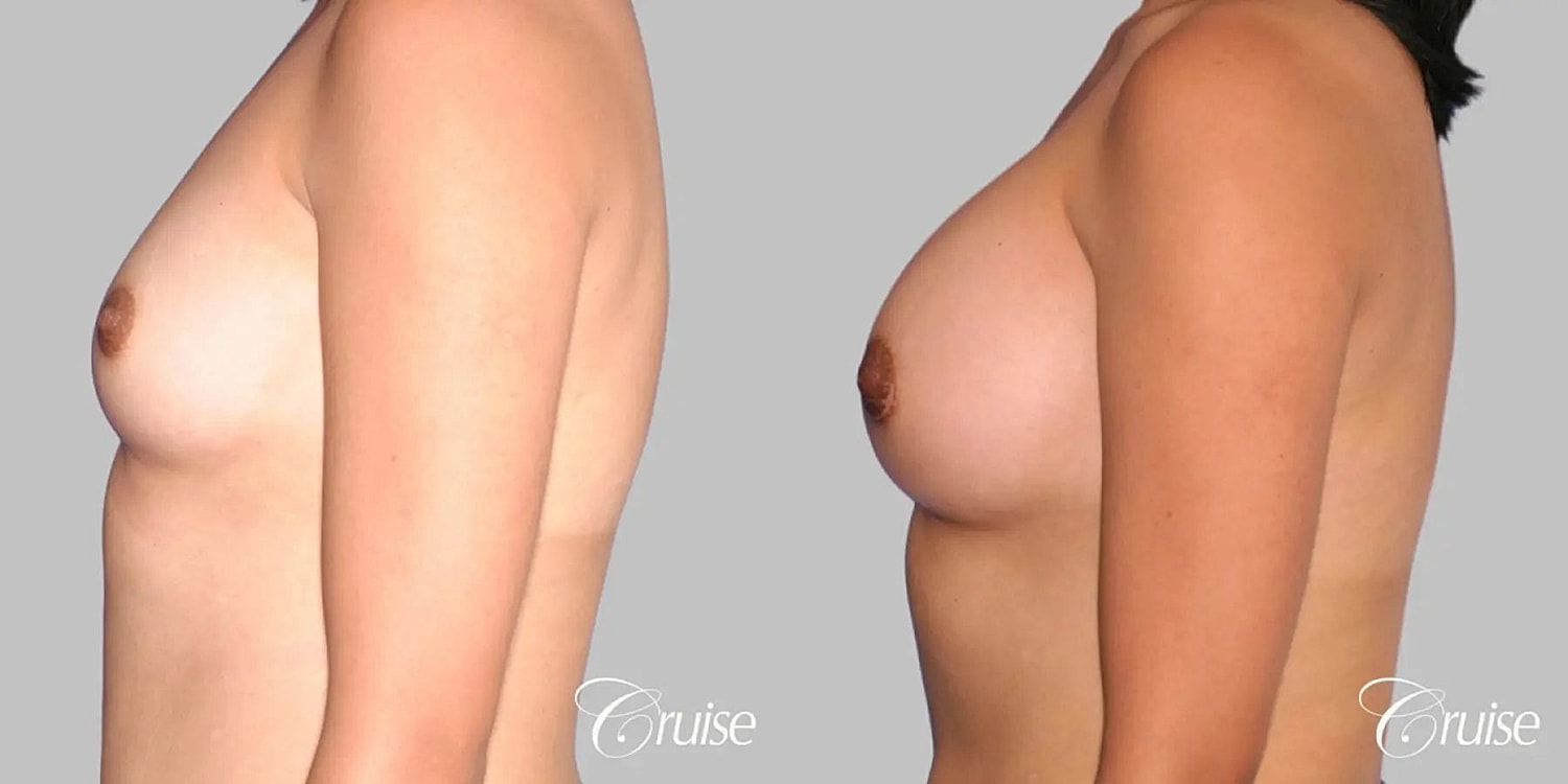 Breast Augmentation Before & After