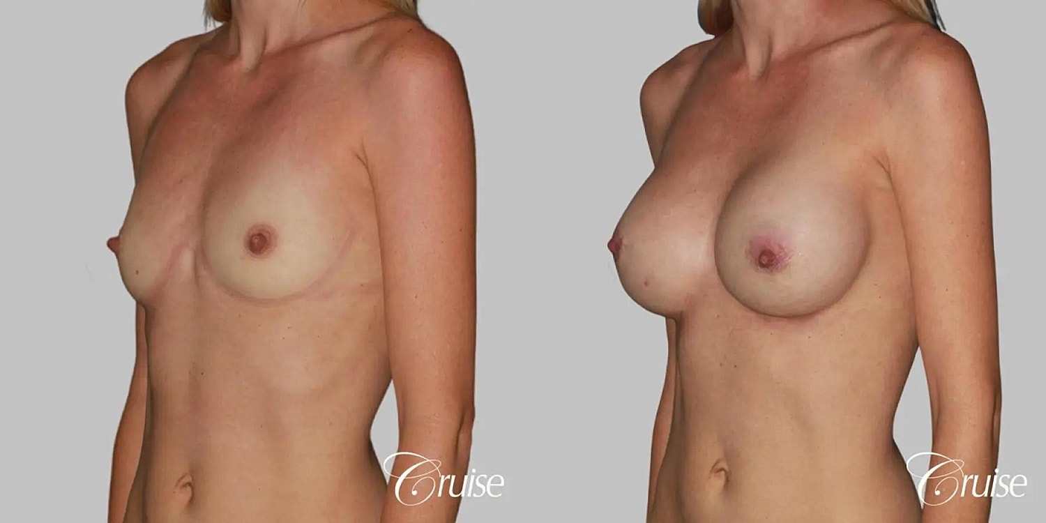 Breast Augmentation Before & After