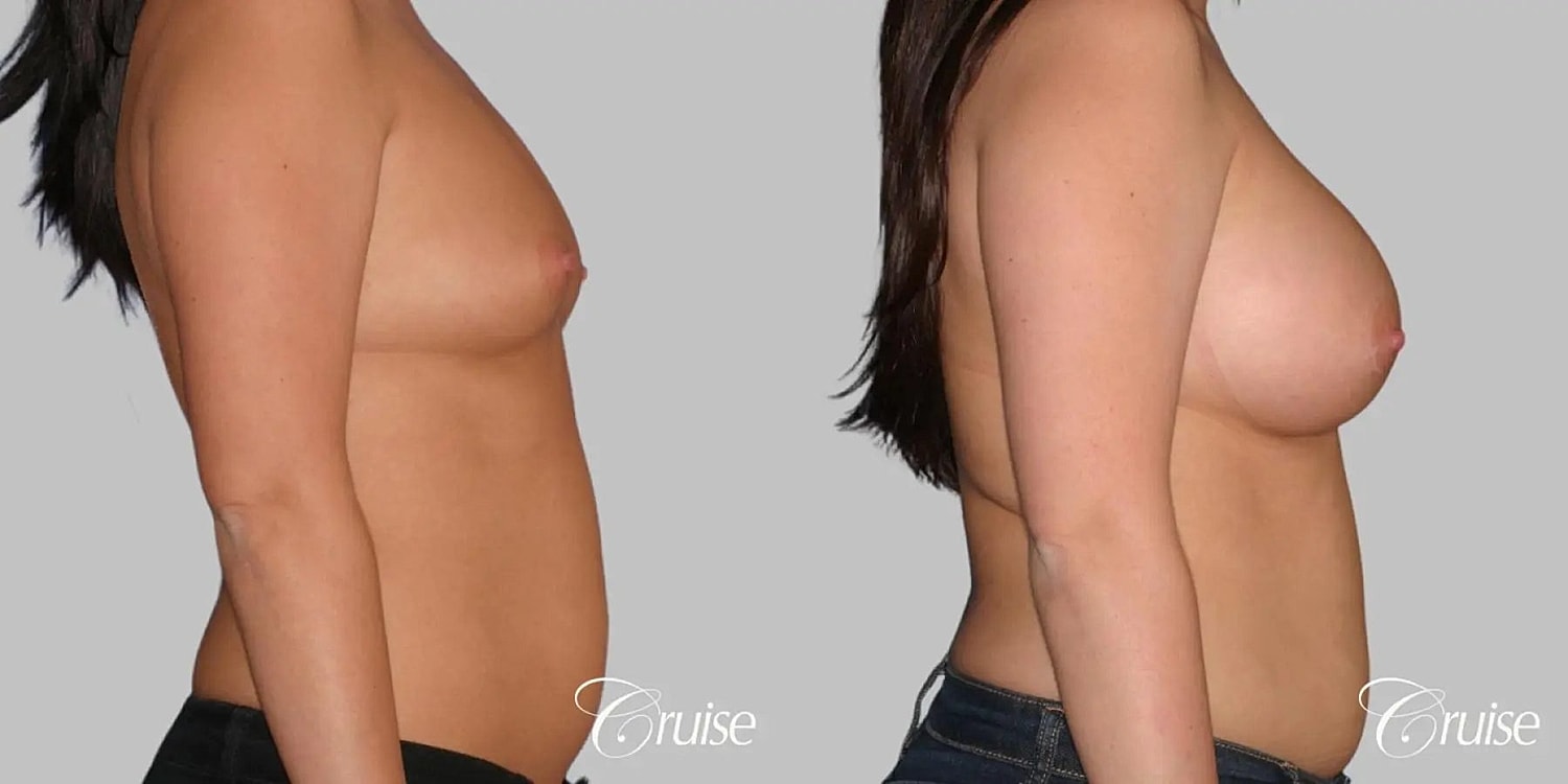 Breast Augmentation Before & After