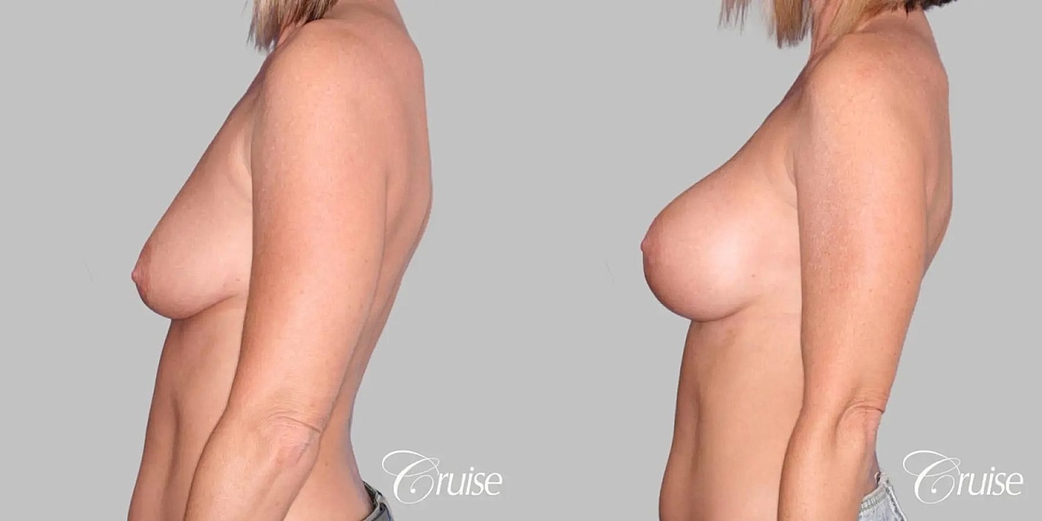 Breast Augmentation Before & After