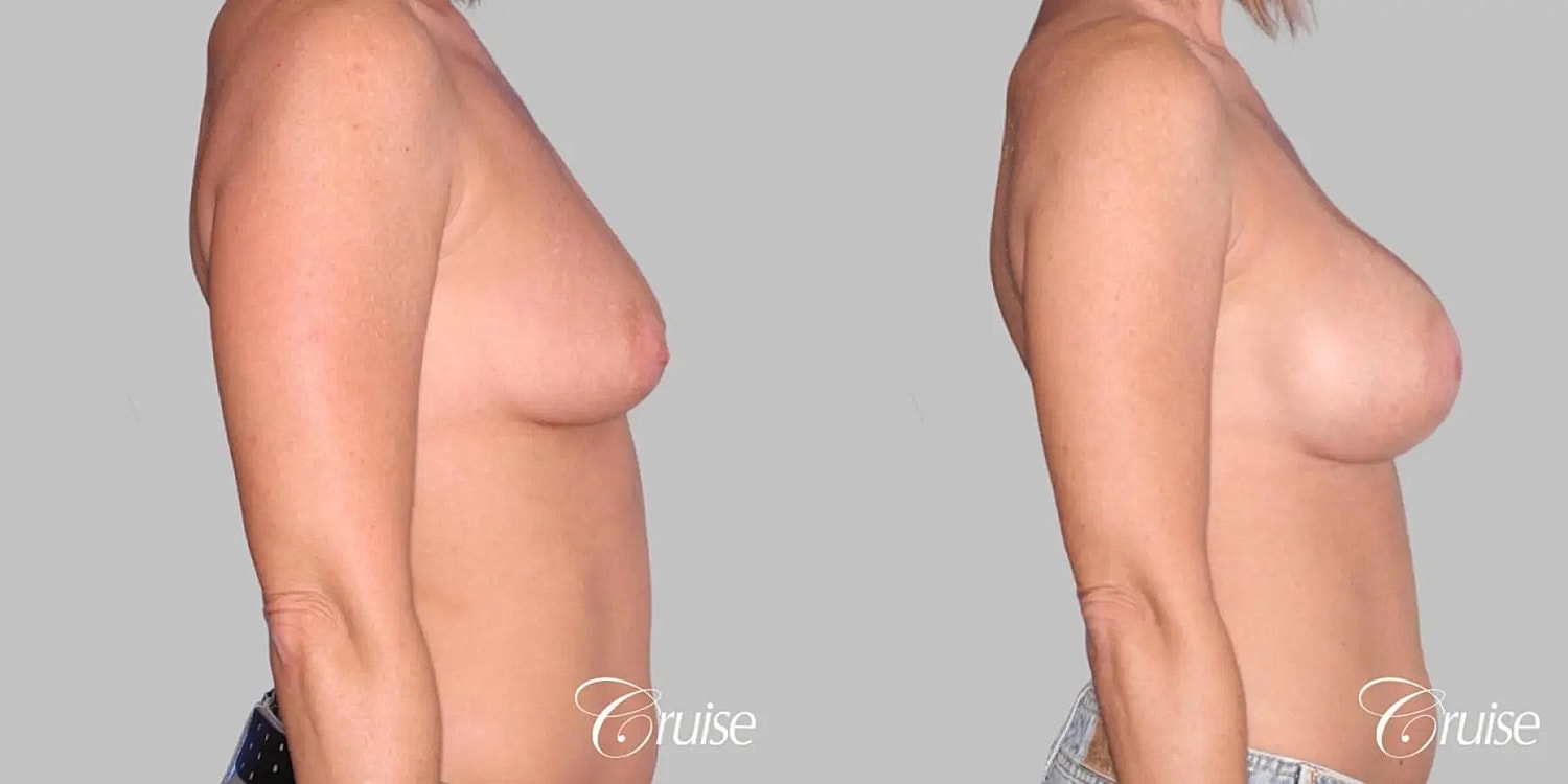 Breast Augmentation Before & After