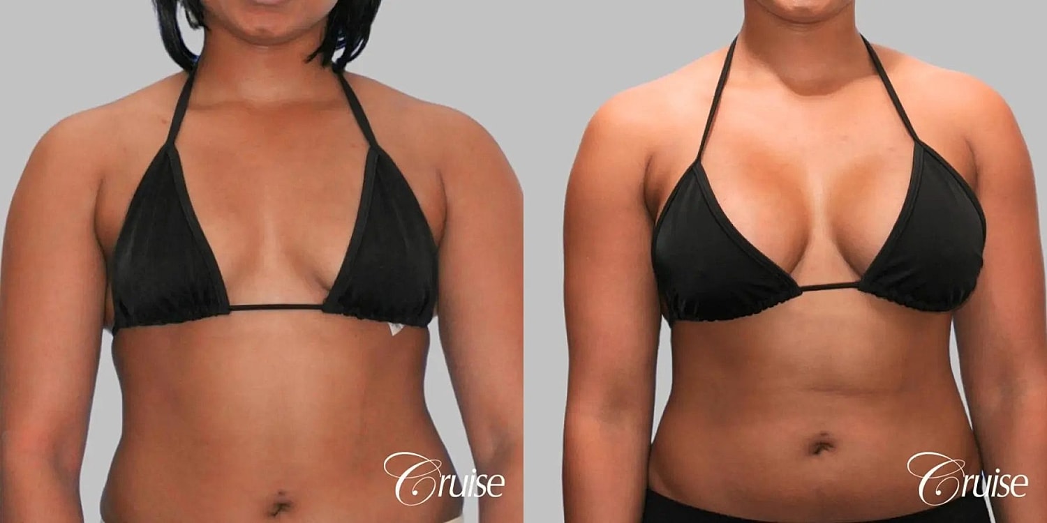 Breast Augmentation Before & After