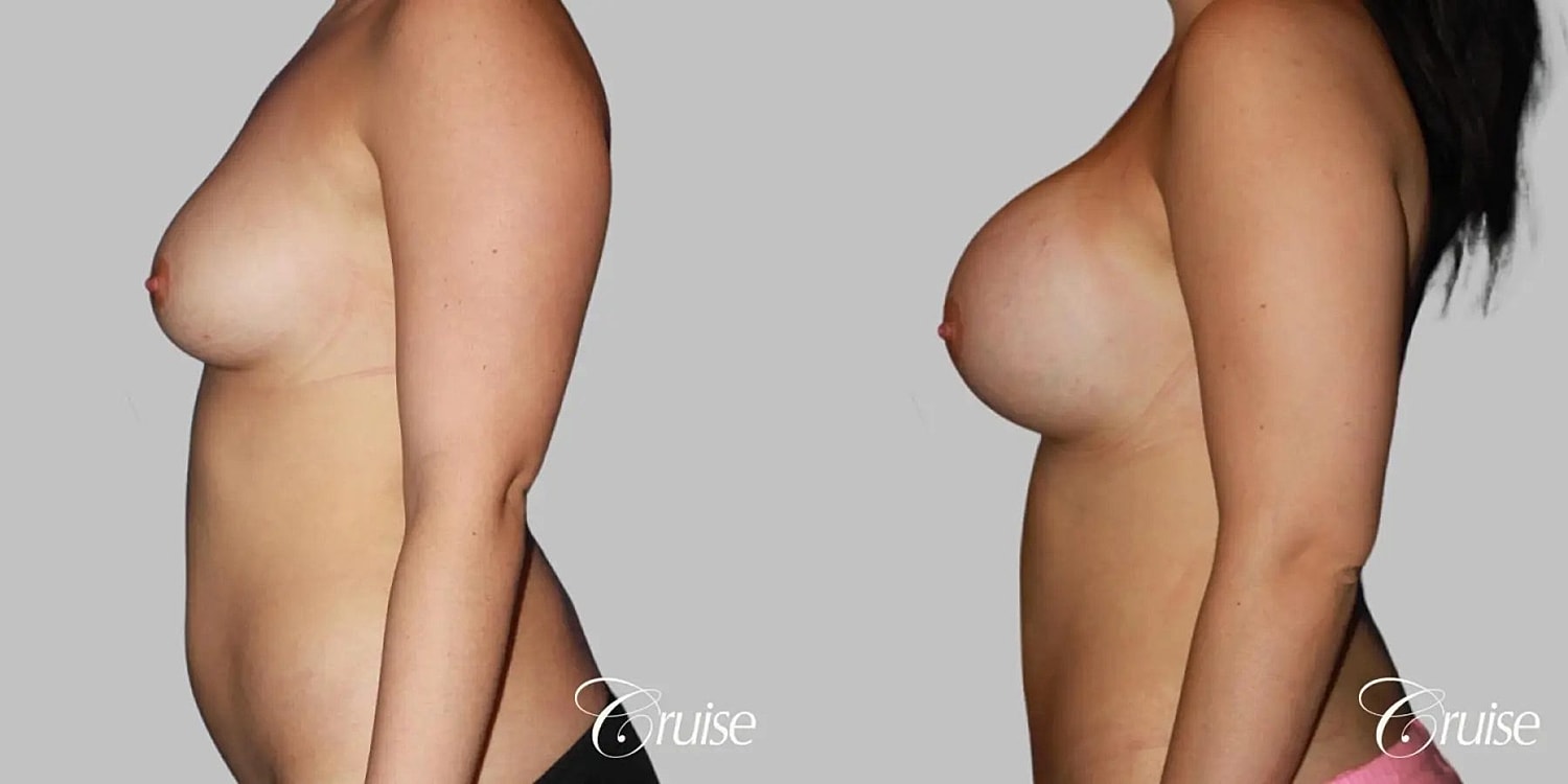 Breast Augmentation Before & After