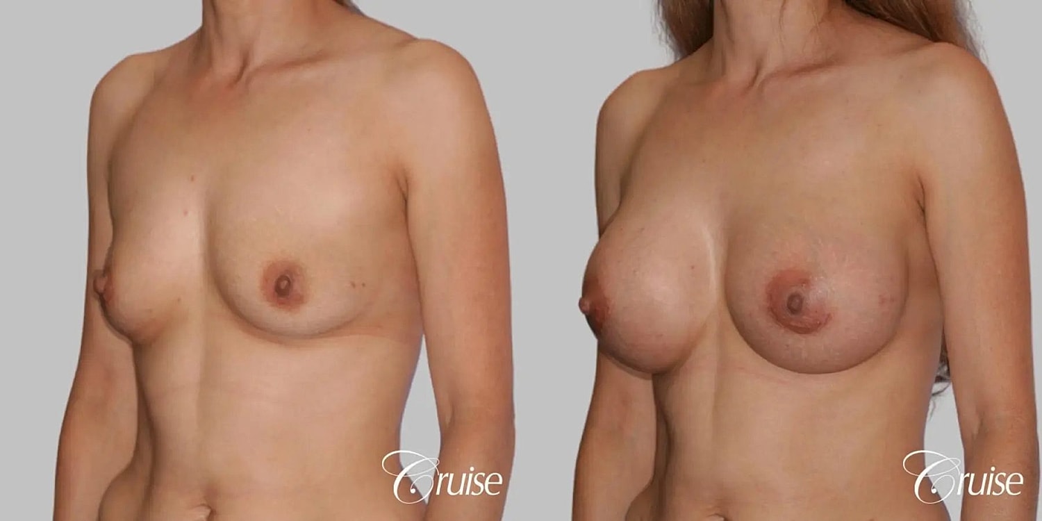 Breast Augmentation Before & After