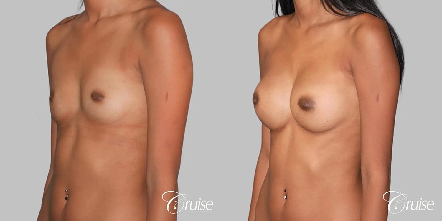 Breast Augmentation Before & After