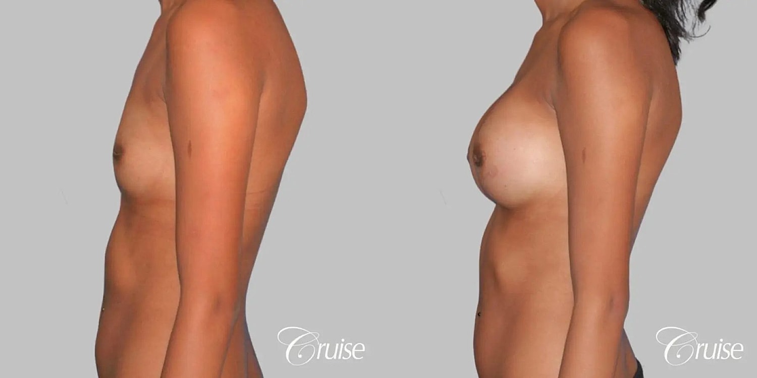 Breast Augmentation Before & After