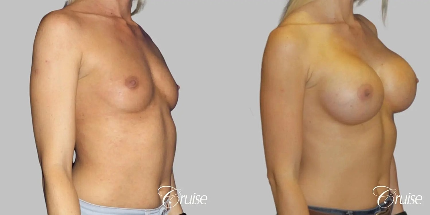 Breast Augmentation Before & After
