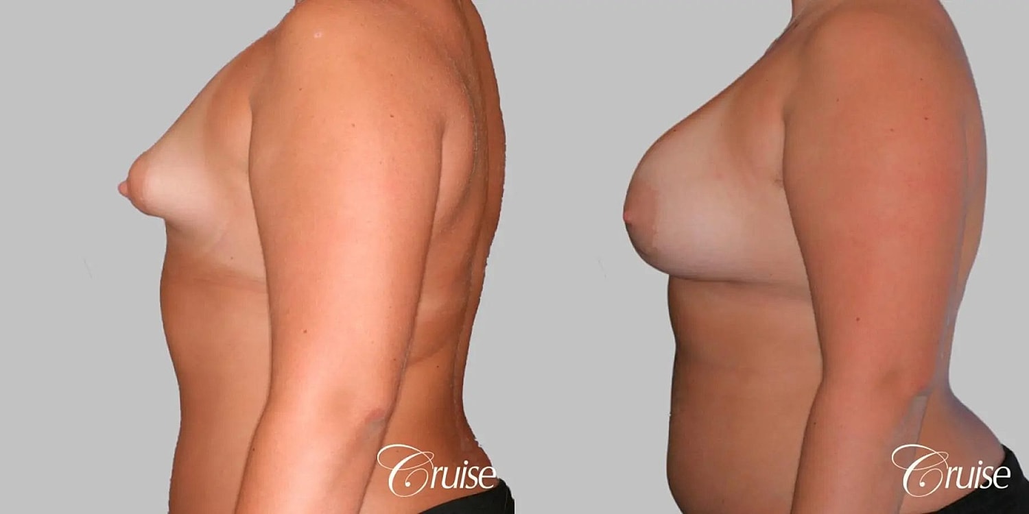 Breast Augmentation Before & After