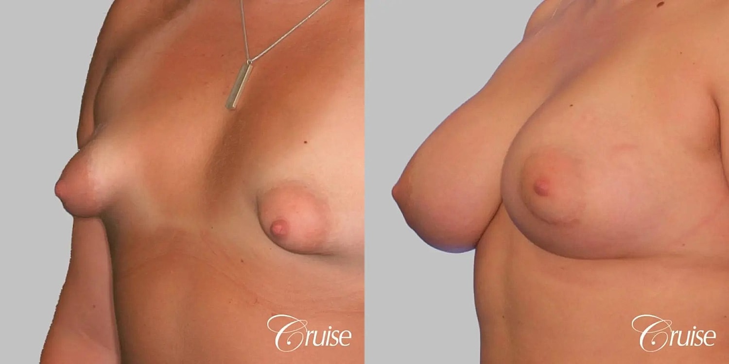 Breast Augmentation Before & After