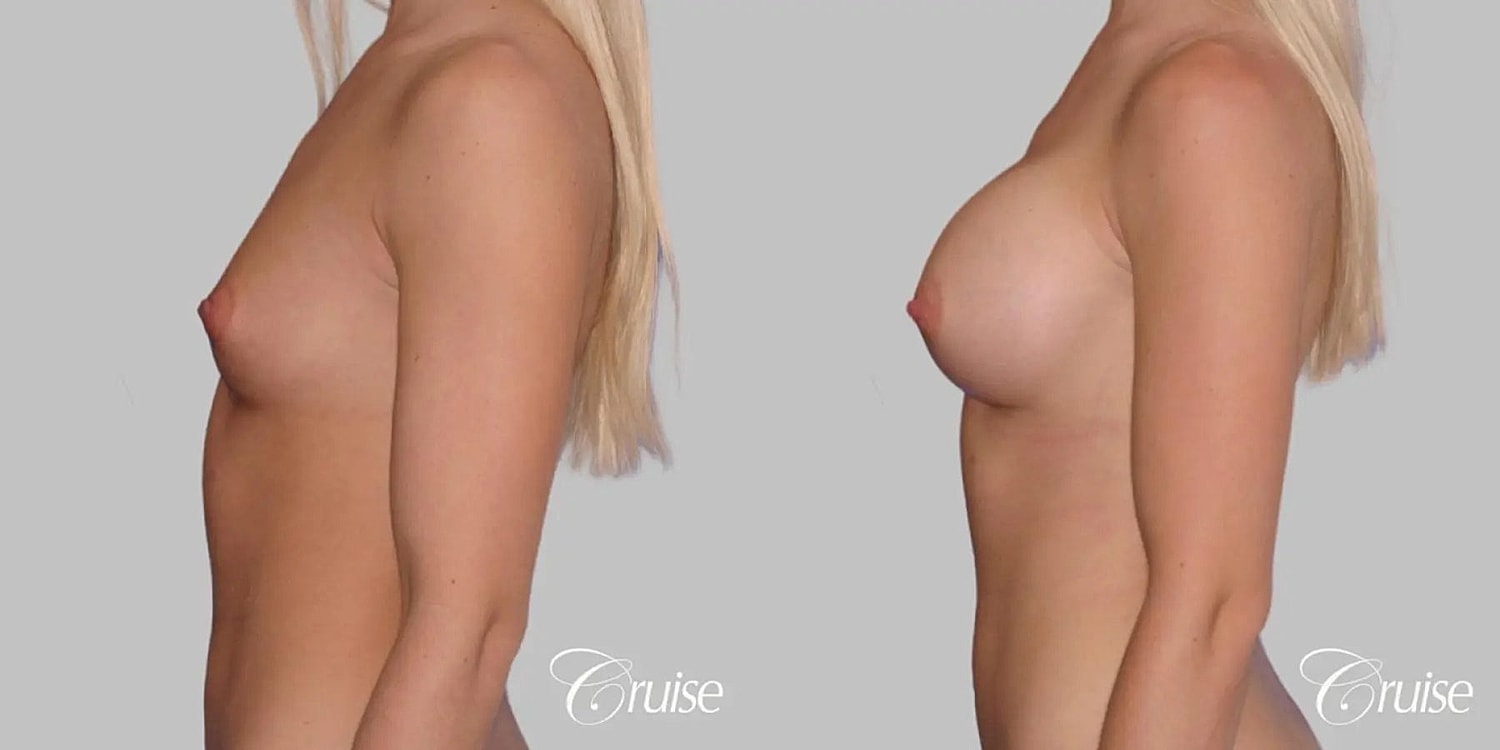 Breast Augmentation Before & After