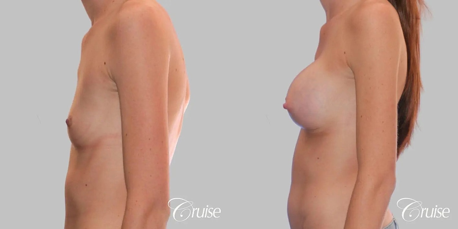 Breast Augmentation Before & After