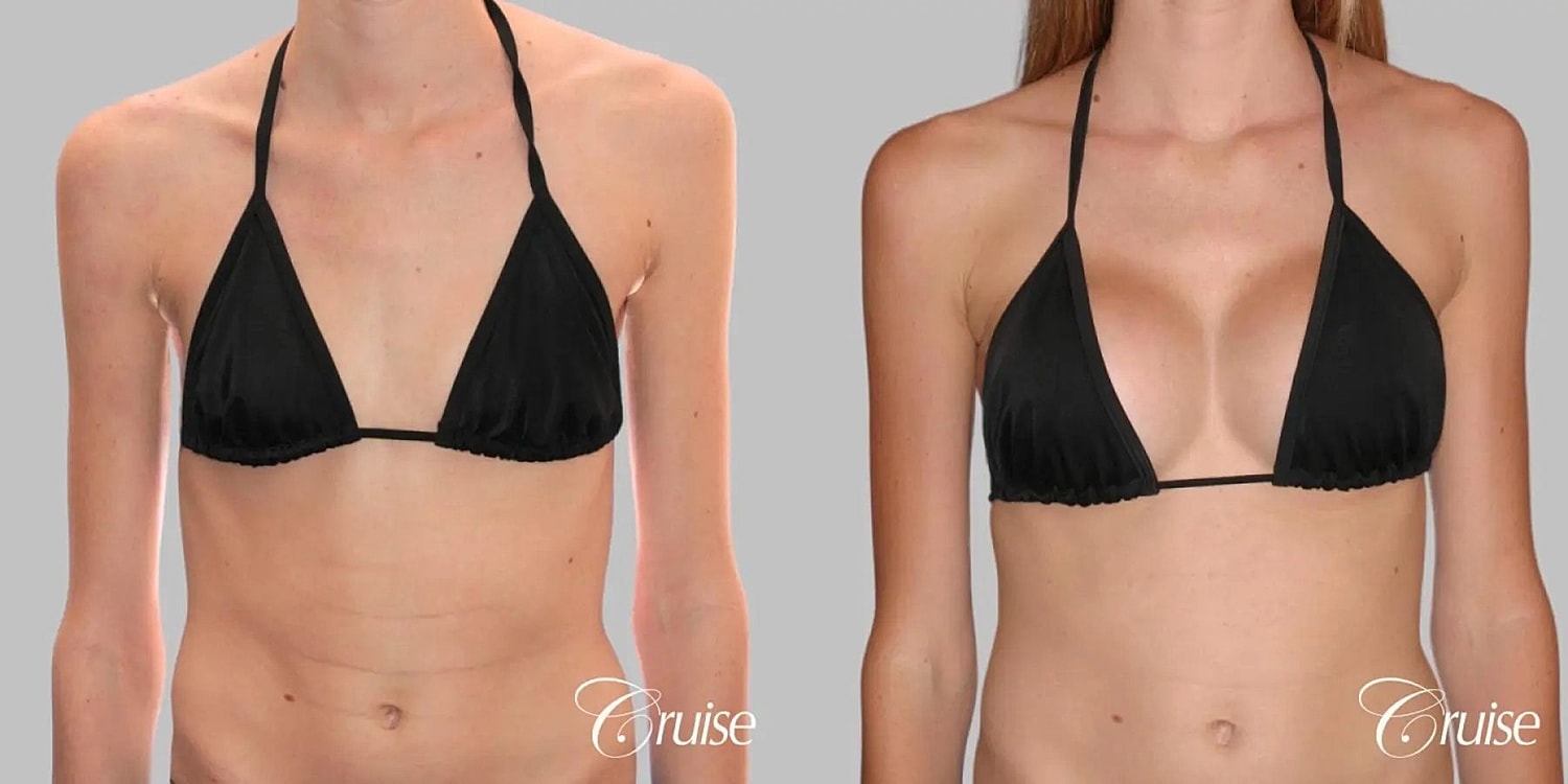 Breast Augmentation Before & After