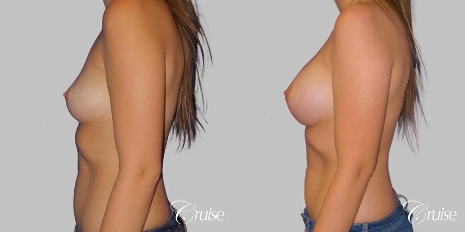 Breast Augmentation Before & After