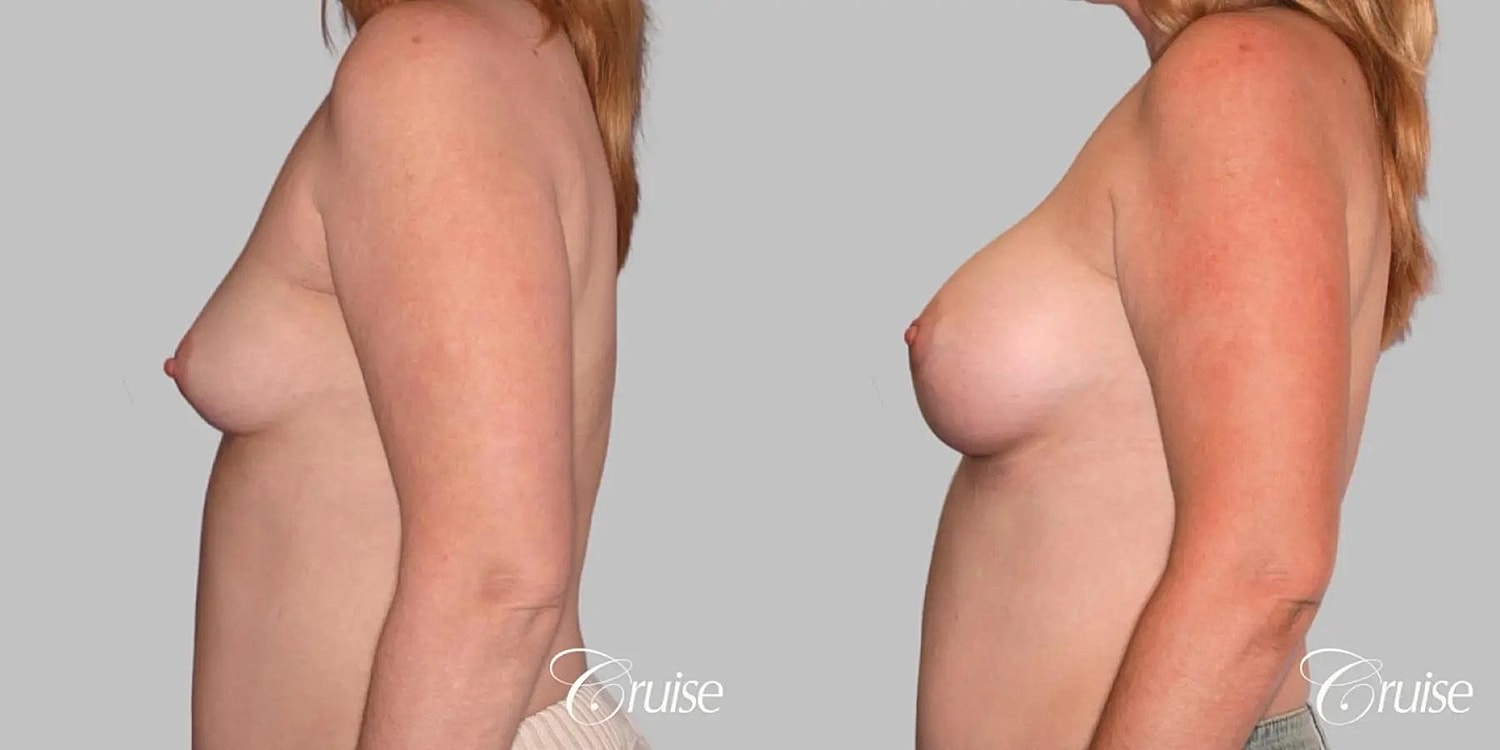 Breast Augmentation Before & After