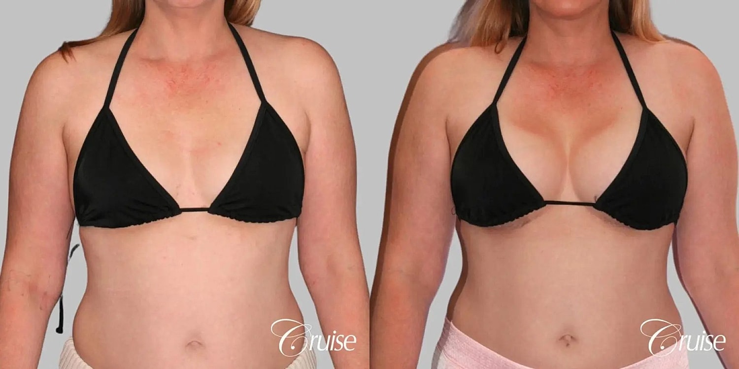Breast Augmentation Before & After