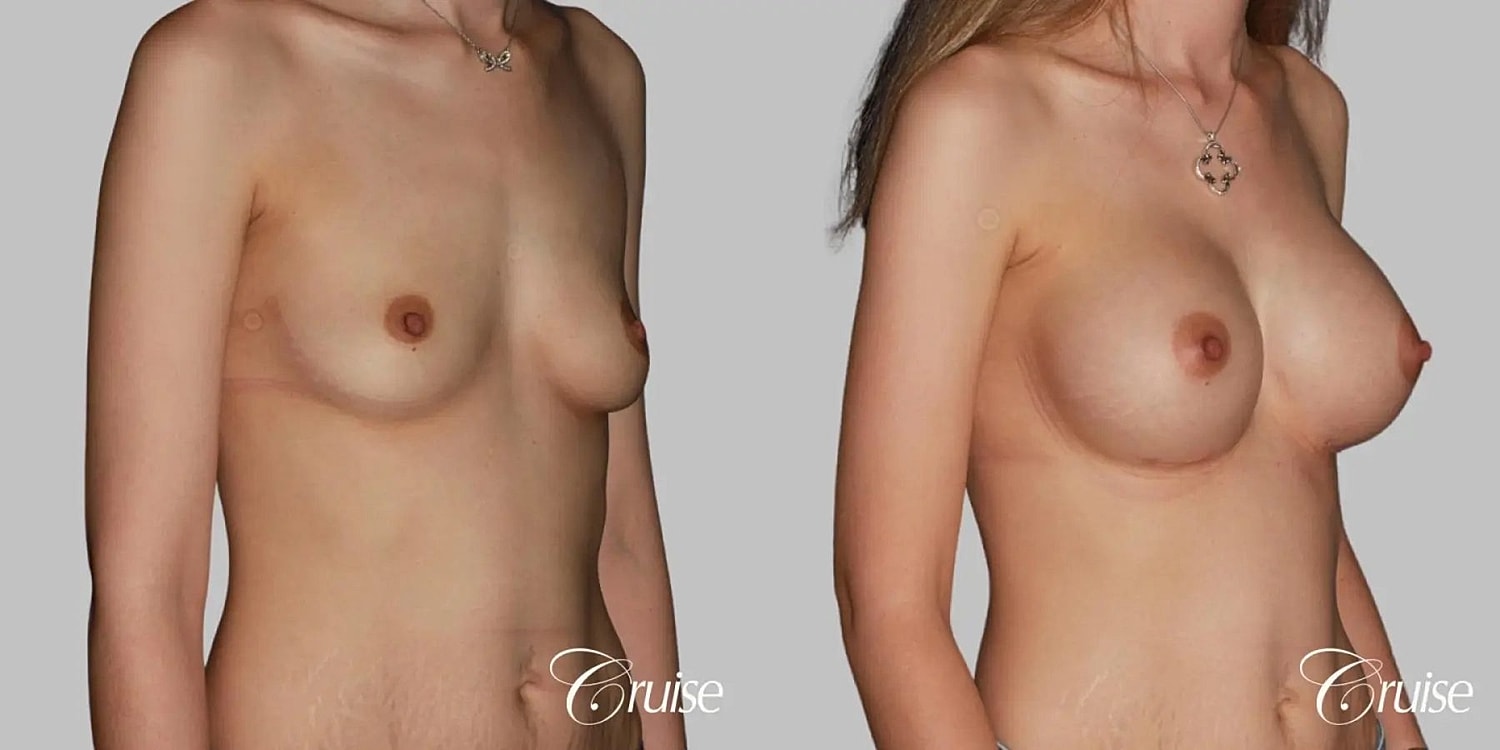 Breast Augmentation Before & After