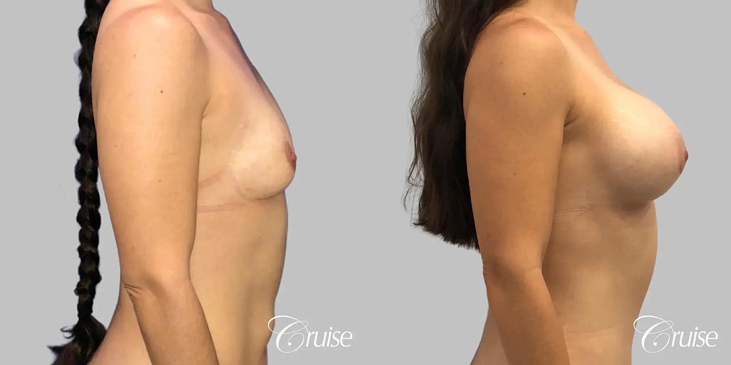 Breast Augmentation Before & After