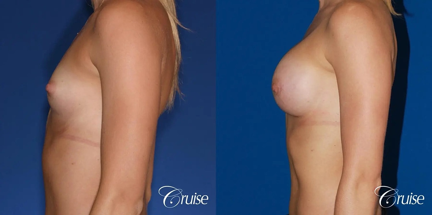 Breast Augmentation Before & After