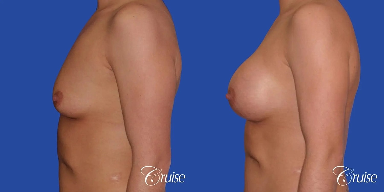Breast Augmentation Before & After