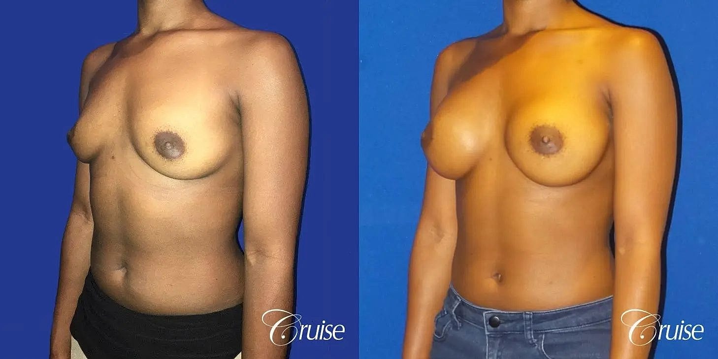 Breast Augmentation Before & After