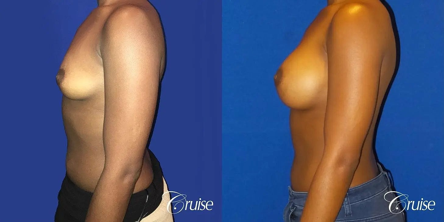 Breast Augmentation Before & After