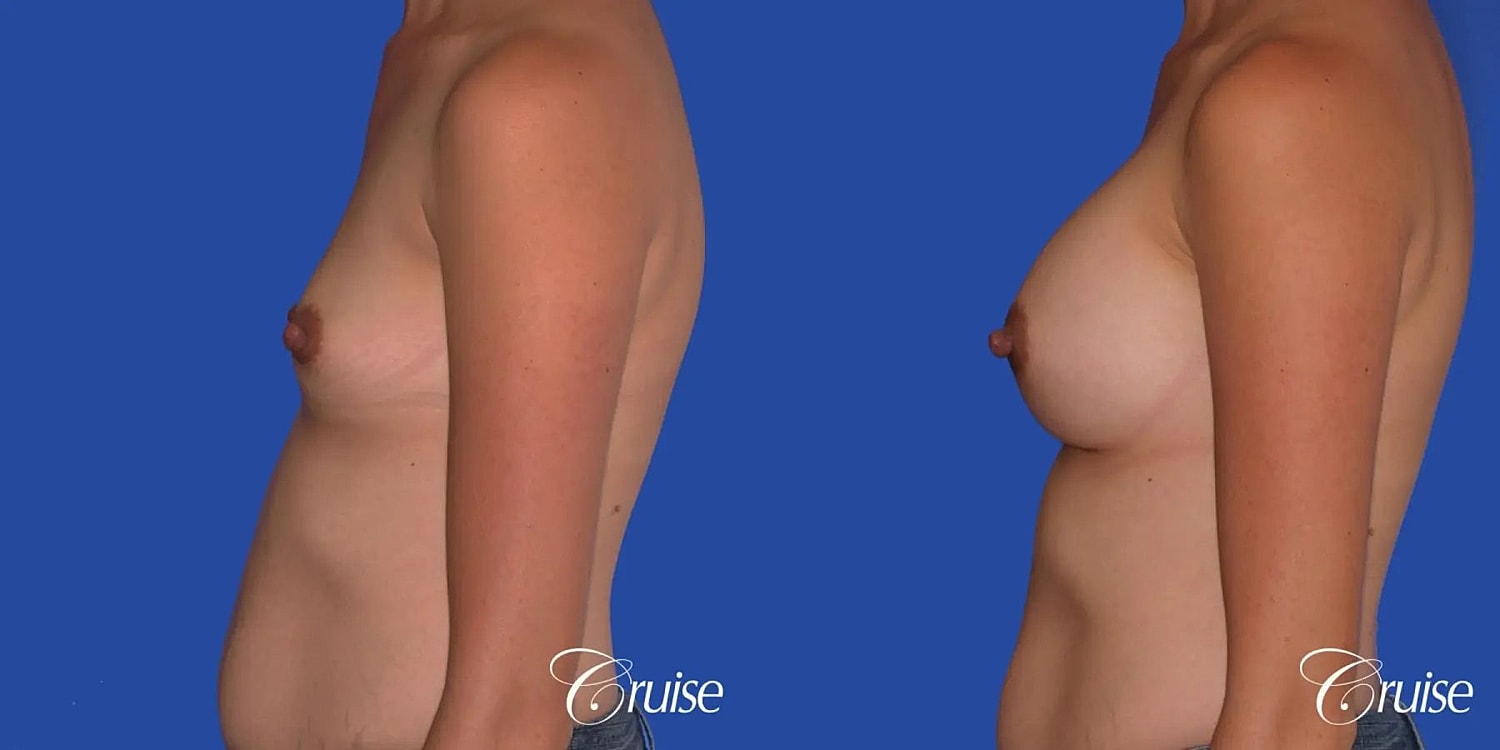 Breast Augmentation Before & After