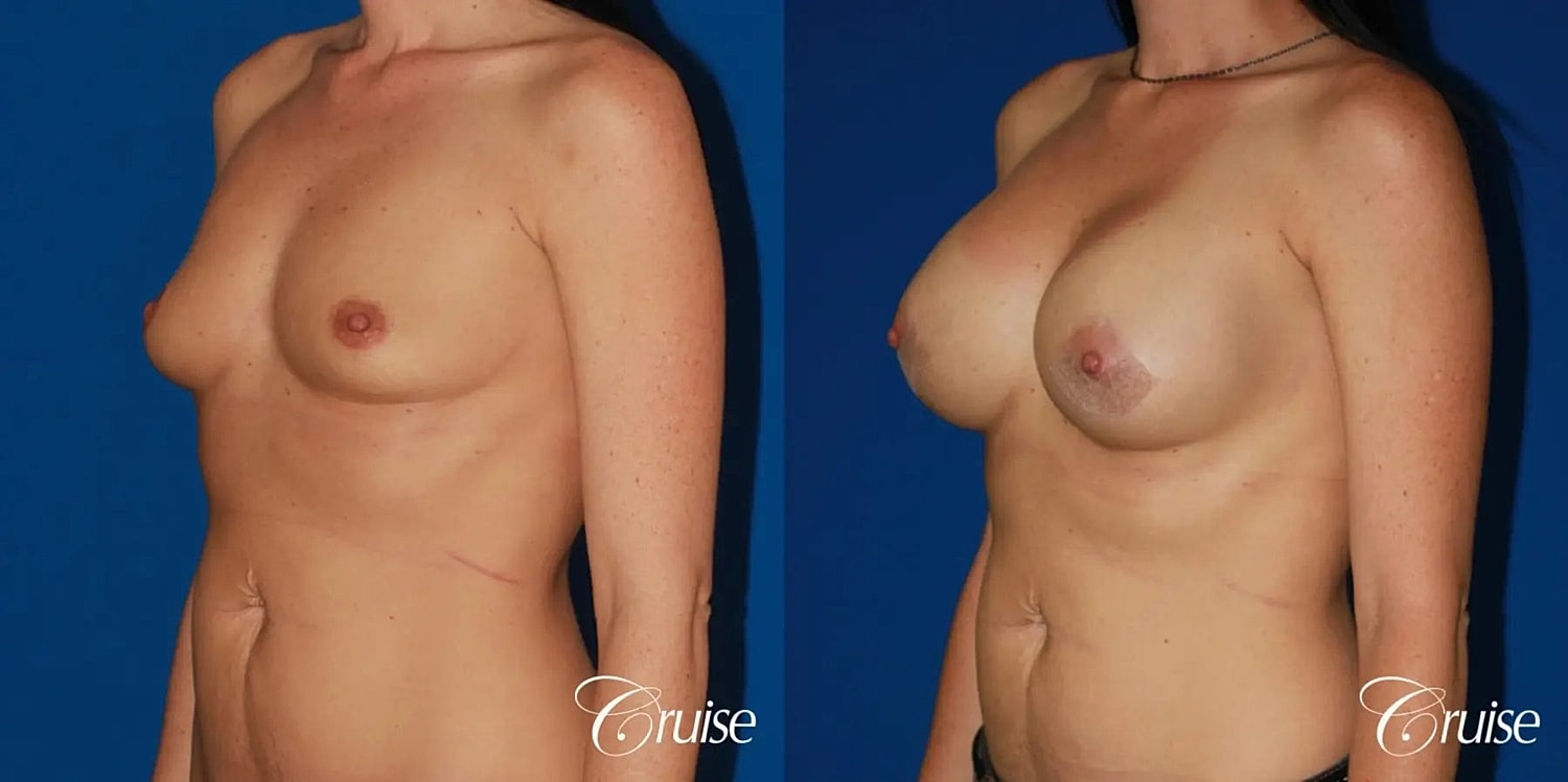 Breast Augmentation Before & After