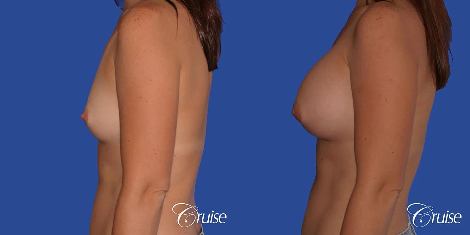 Breast Augmentation Before & After