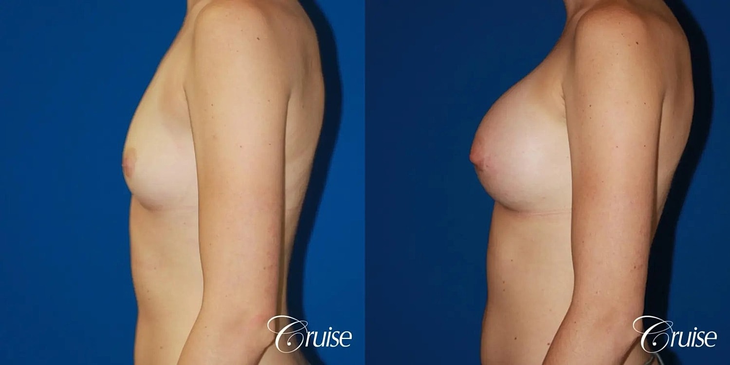 Breast Augmentation Before & After