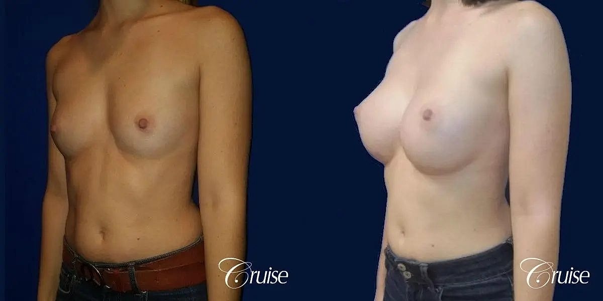 Breast Augmentation Before & After