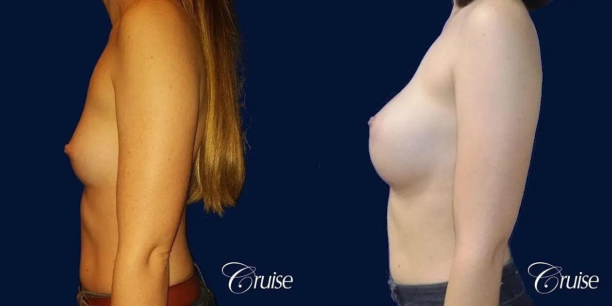 Breast Augmentation Before & After
