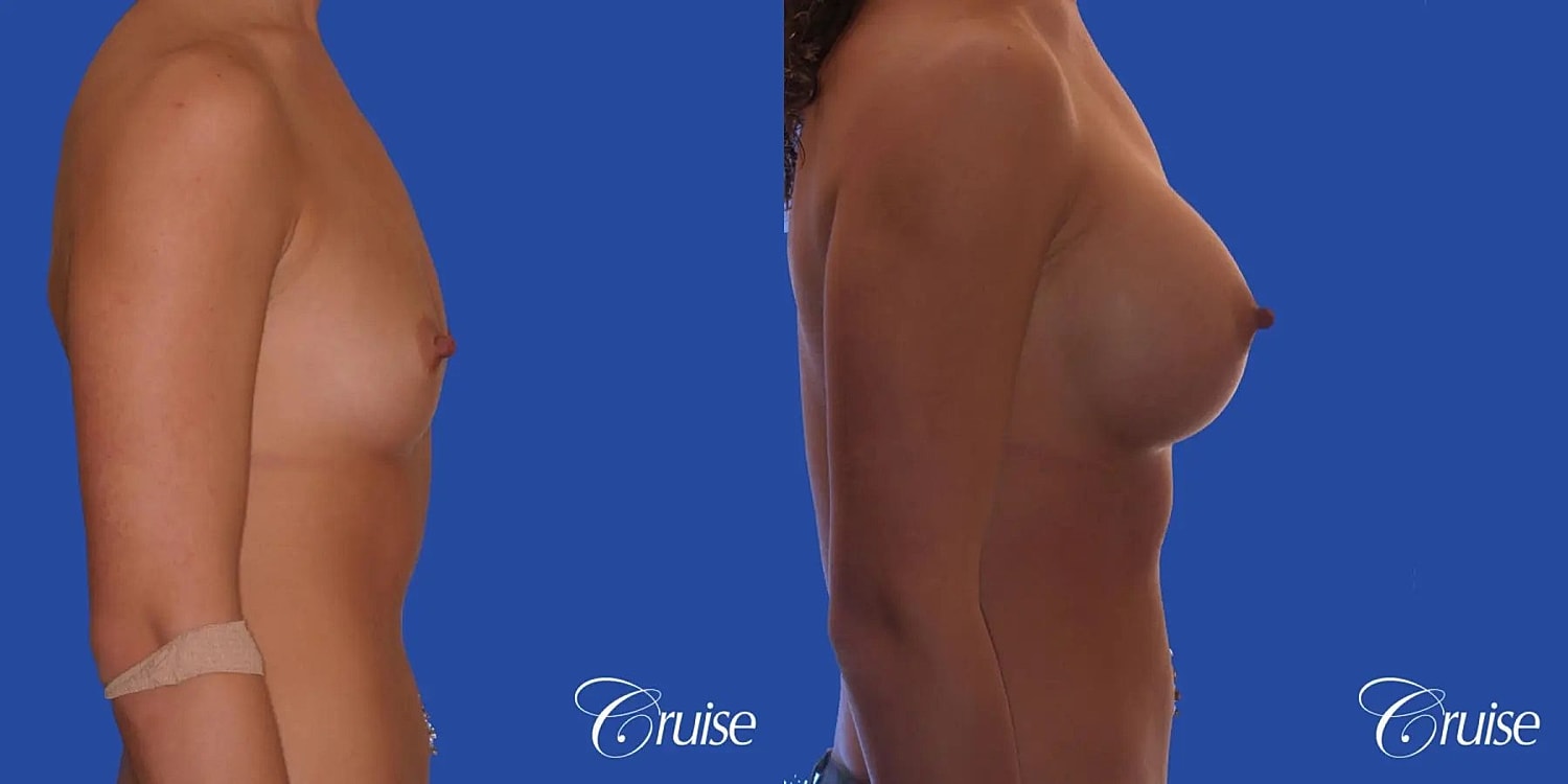 Breast Augmentation Before & After