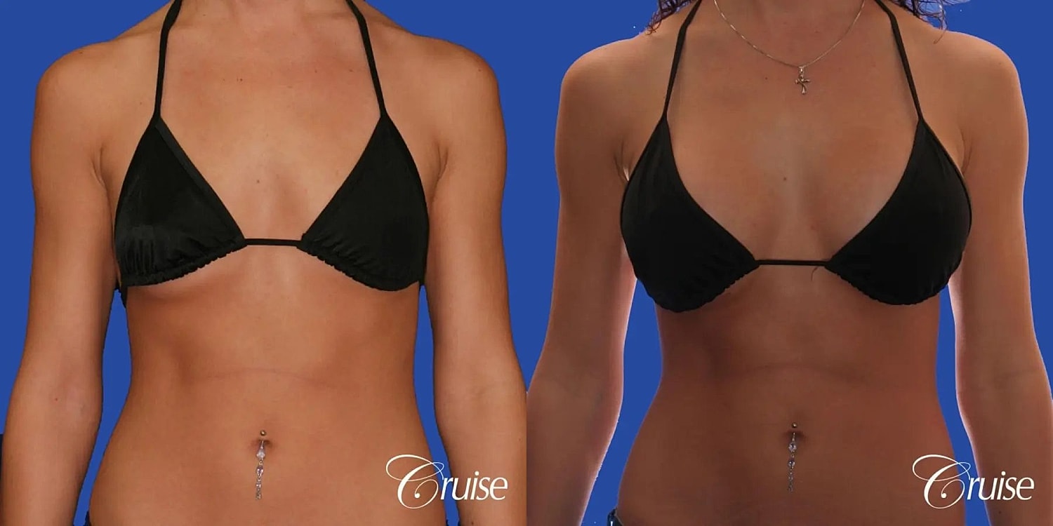Breast Augmentation Before & After