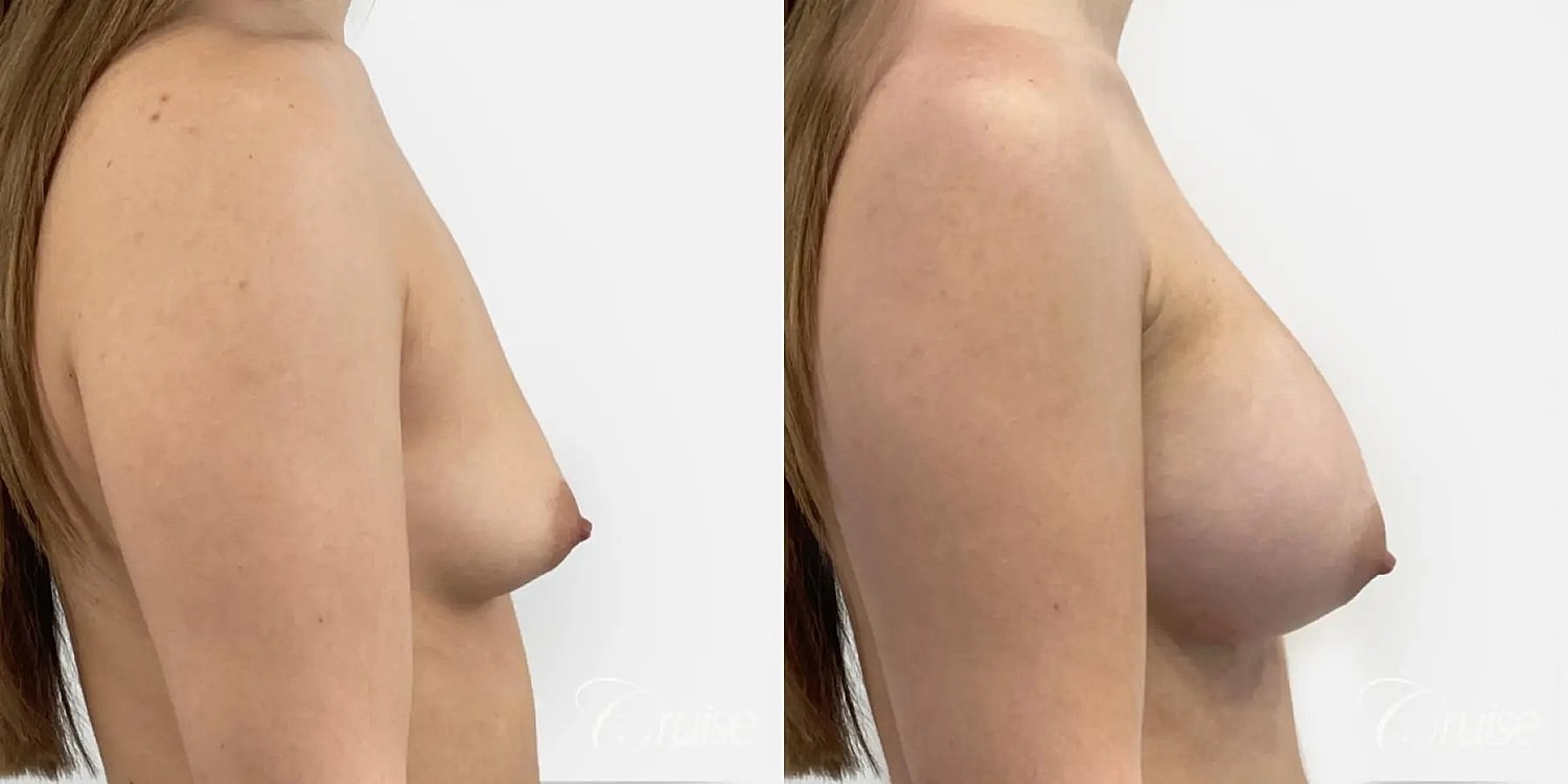 Breast Augmentation Before & After