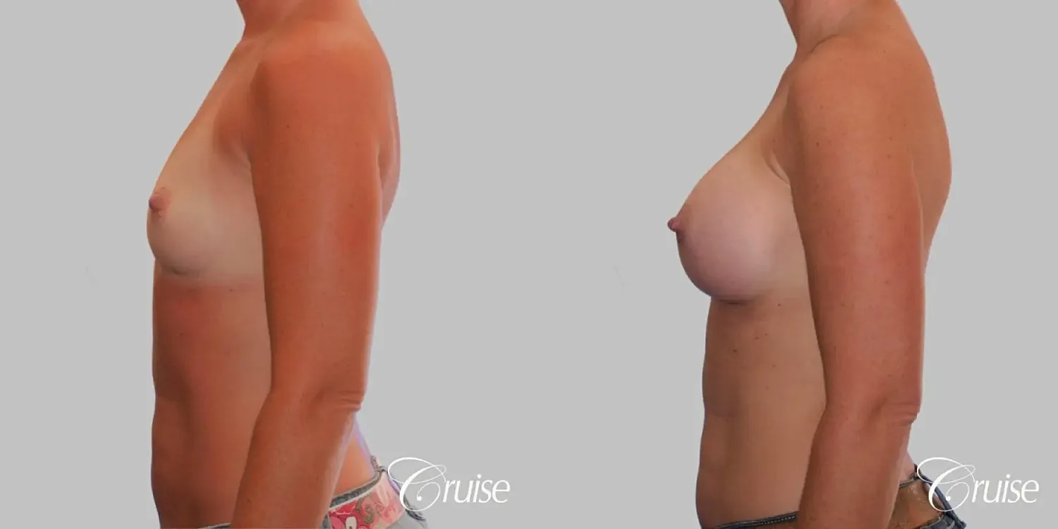 Breast Augmentation  Before & After