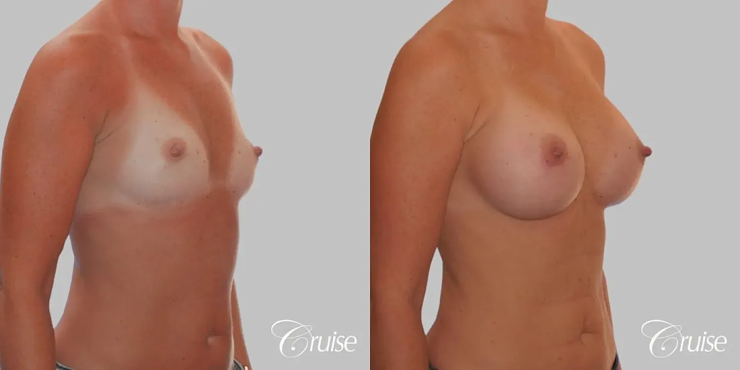 Breast Augmentation  Before & After