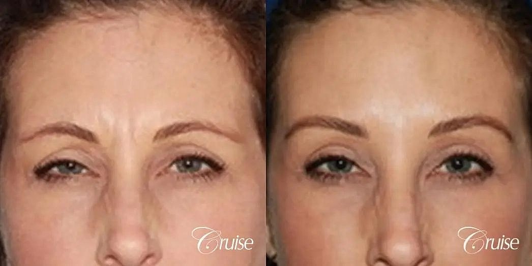 Botox Cosmetic Before & After