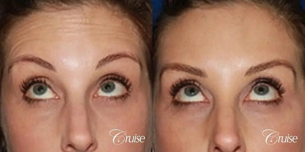 Botox Cosmetic Before & After