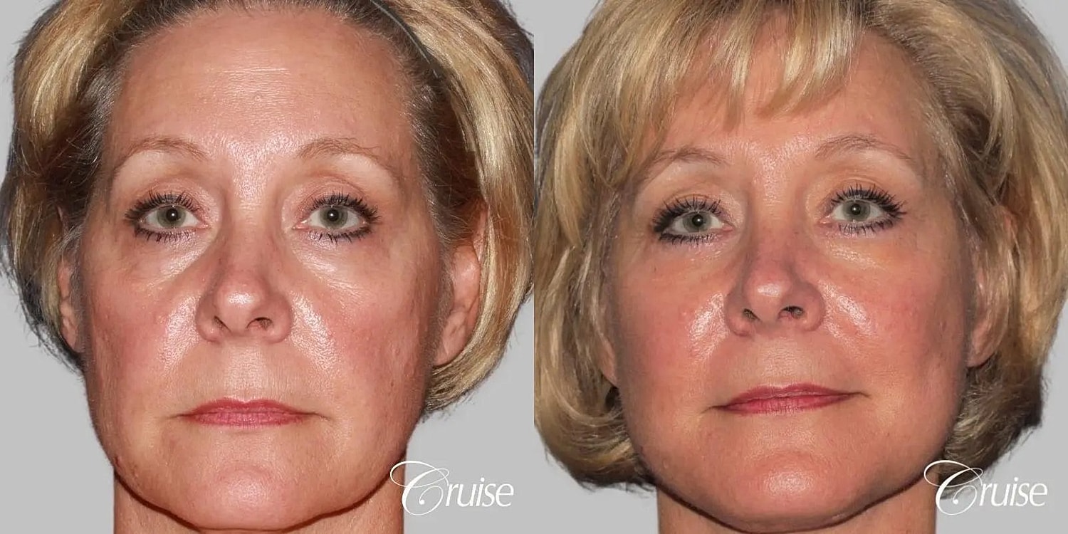 Facial Fat Transfer Before & After