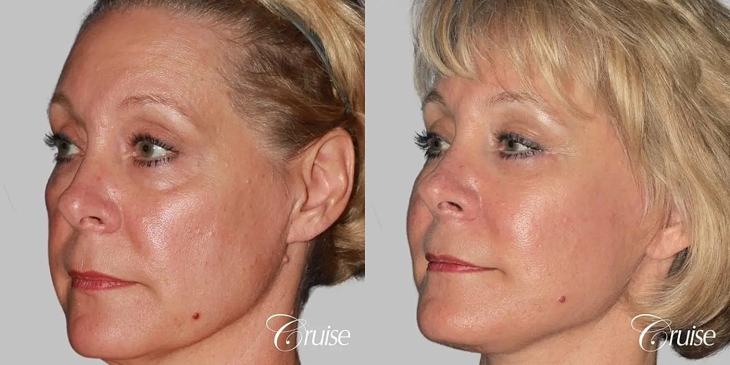Facial Fat Transfer Before & After