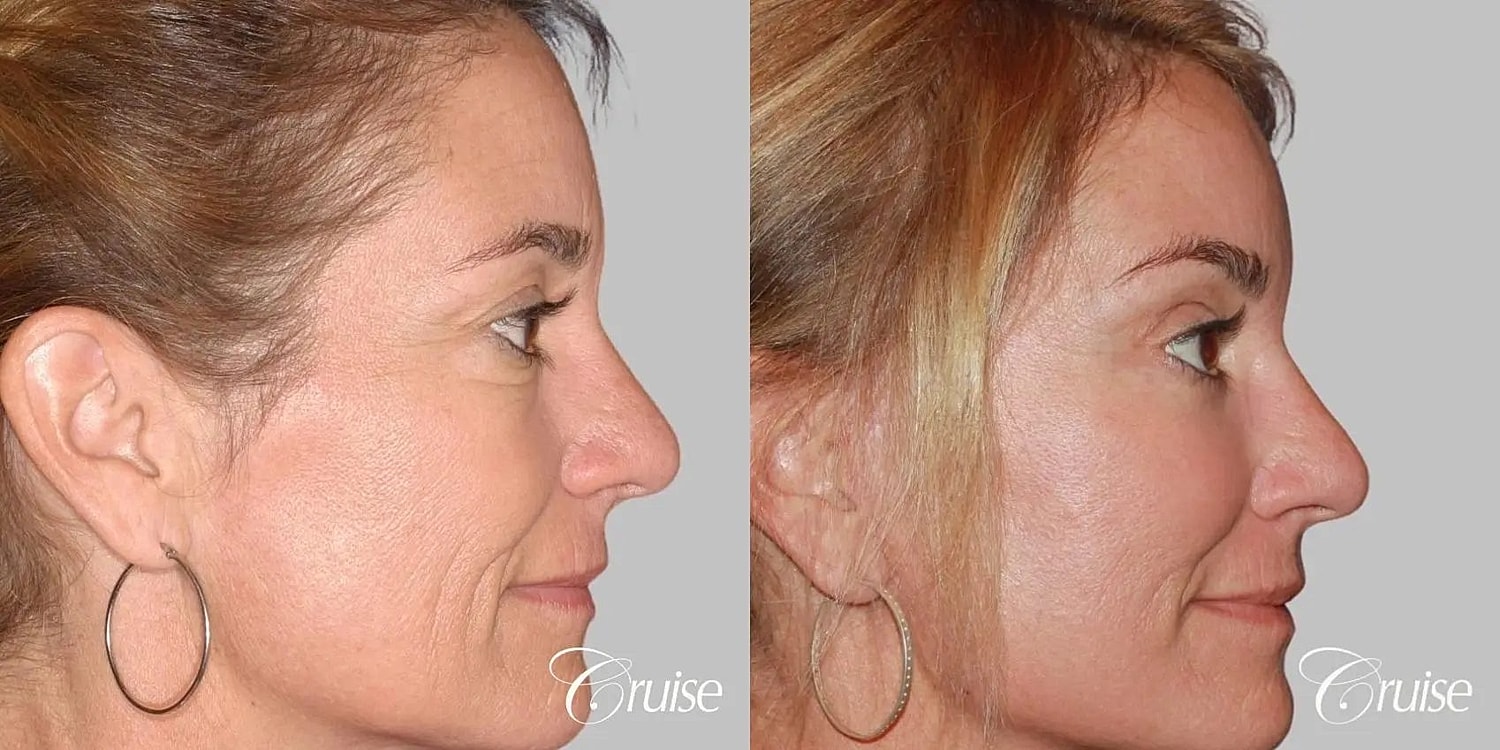 Facial Fat Transfer Before & After