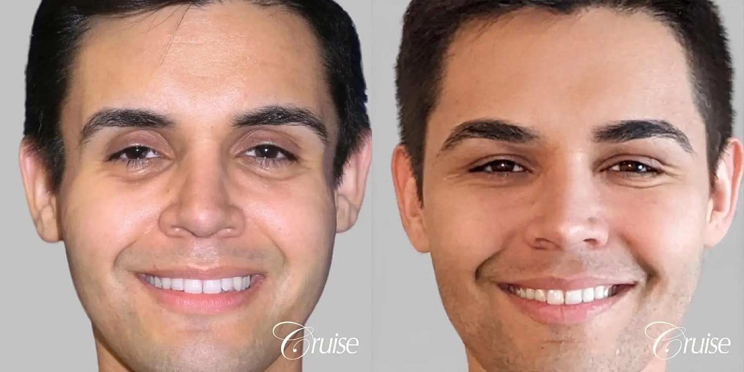 Facial Fat Transfer Before & After